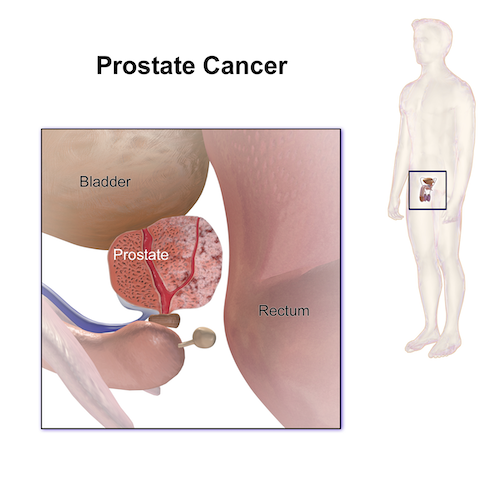 Schéma prostate