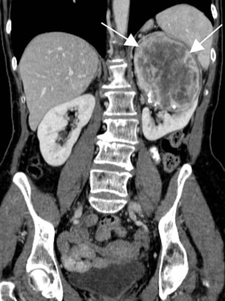 Radiographie d'une tumeur du rein